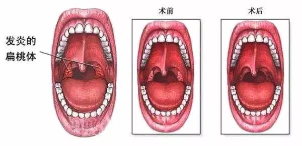 扁桃体炎的护理方法有哪些