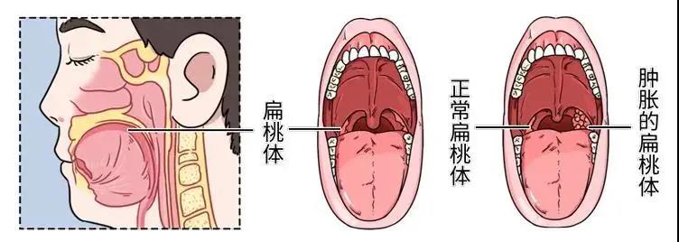 张口呼吸